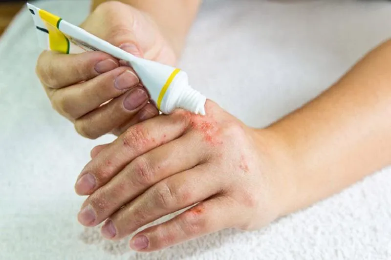 Lưu ý chung khi sử dụng thuốc bôi trị ngứa