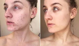 Miếng dán trị mụn cao cấp giúp làn da mịn màng không tì vết