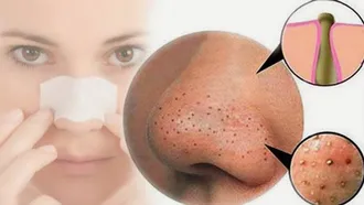Top 6 sản phẩm trị mụn đầu đen hiệu quả nhất hiện nay