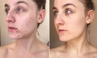 Review 6 miếng dán trị mụn tốt nhất: 'vũ khí' che và trị mụn cấp tốc