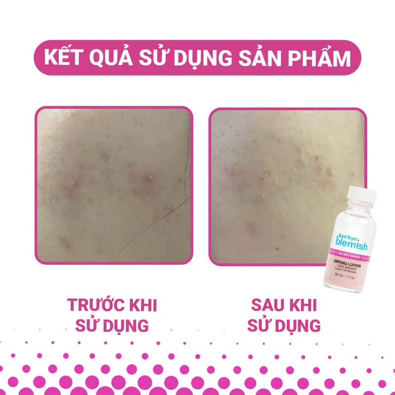 Trải nghiệm sử dụng Bye Bye Blemish Drying Lotion chấm mụn qua đêm