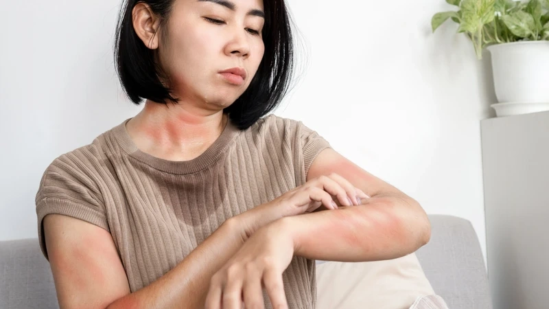 Da bị ngứa nổi mẩn đỏ do nắng nóng mùa hè