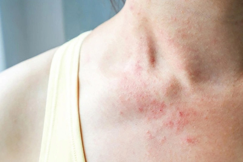 Da nổi mề đay mẩn ngứa do dị ứng
