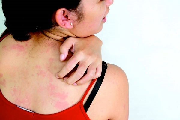 Da bị viêm đỏ kích ứng do tiếp xúc hóa chất hoặc côn trùng